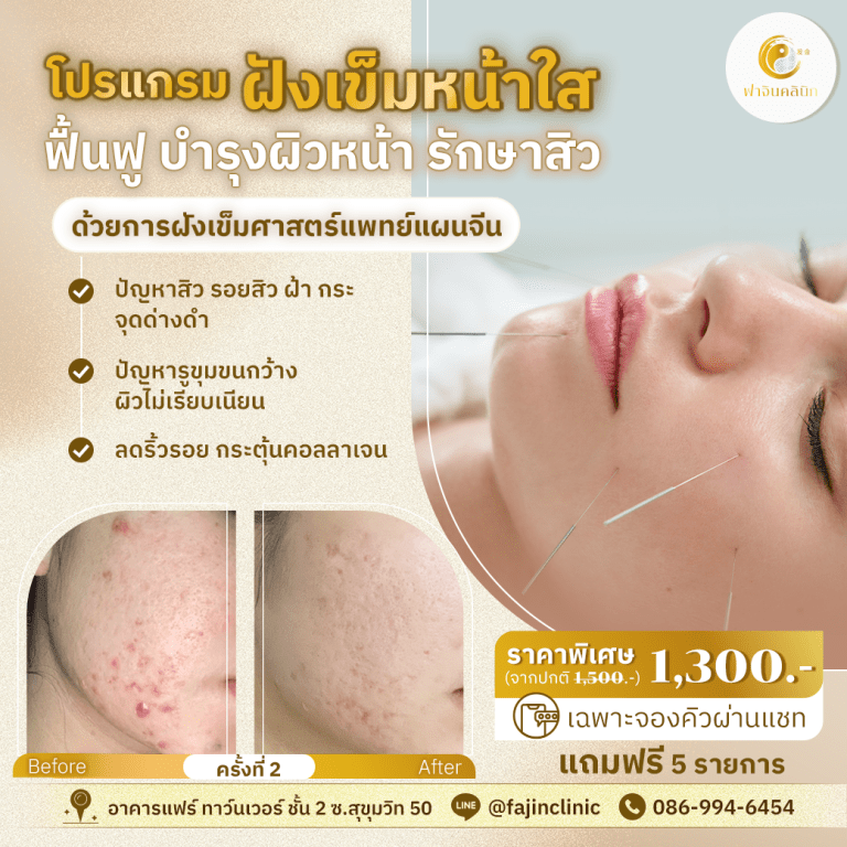 โปรโมชั่น ฝังเข็ม หน้าใส ลดสิว หน้าเรียบเนียน กระจ่างใส