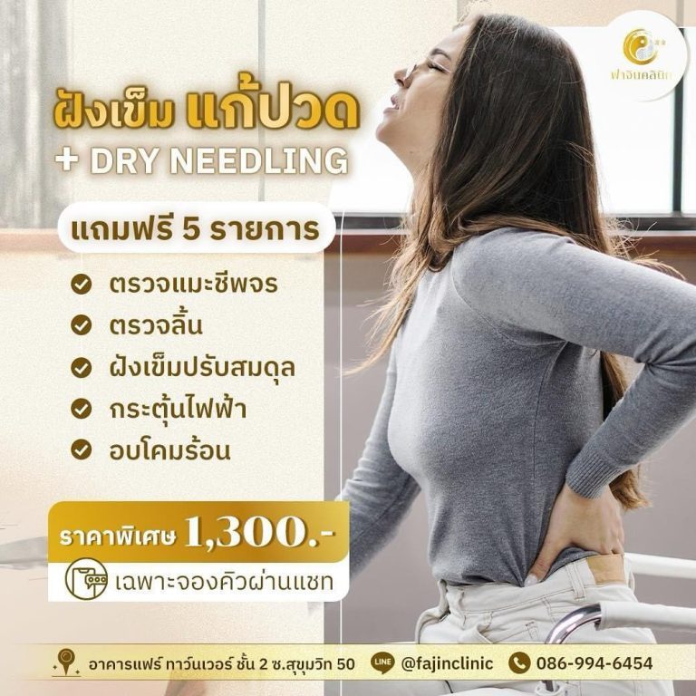 โปรโมชั่น ฝังเข็ม แก้ปวด