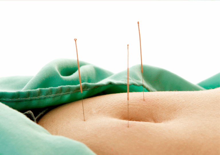 ฝังเข็ม กรดไหลย้อน ปวดท้อง โรคกระเพาะ