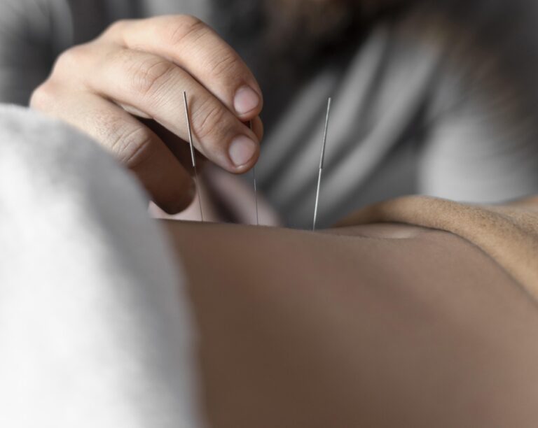 ฝังเข็ม ปรับสมดุล ปรับฮอร์โมน ลดความกังวล ประจำเดือนมาไม่ปกติ
