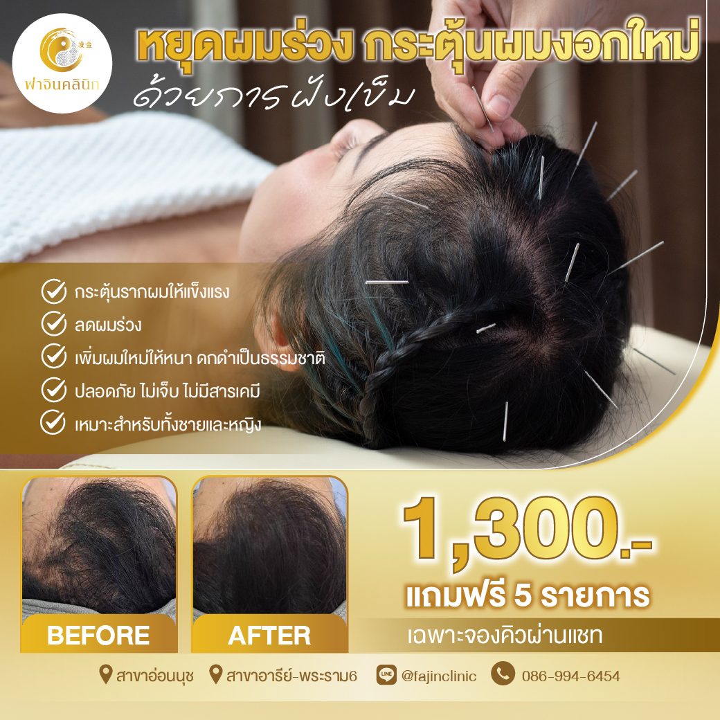 โปรโมชั่น ฝังเข็มรักษาผมร่วง ผมบาง