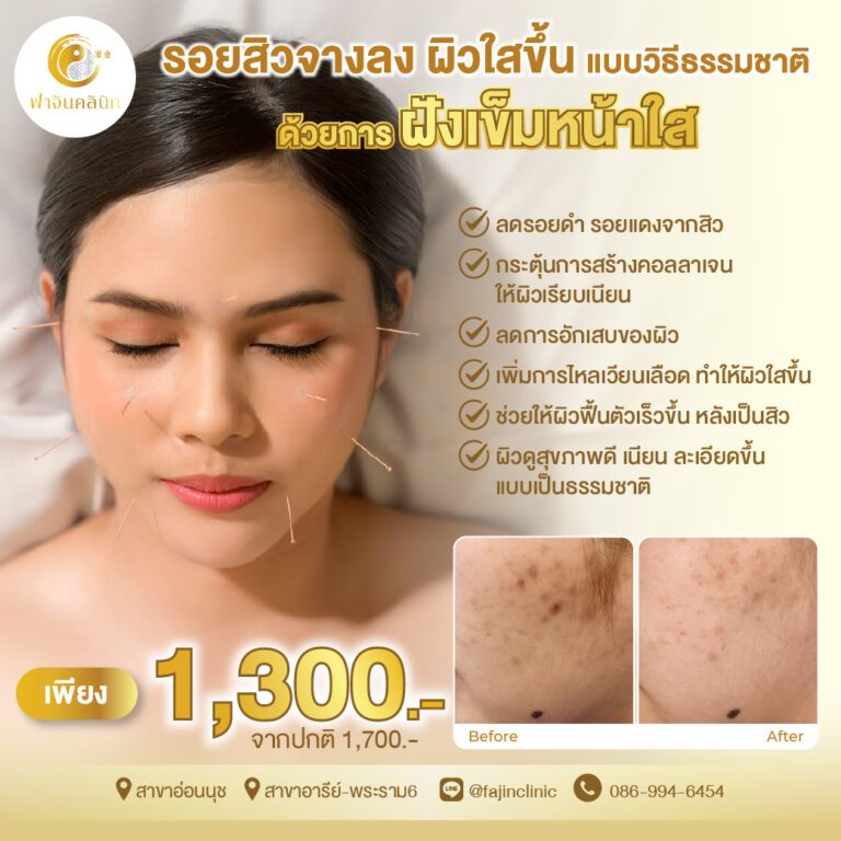 โปรโมชั่น ฝังเข็มหน้าใส รอยสิวจางลง ผิวใส ลดสิว ลดรอย