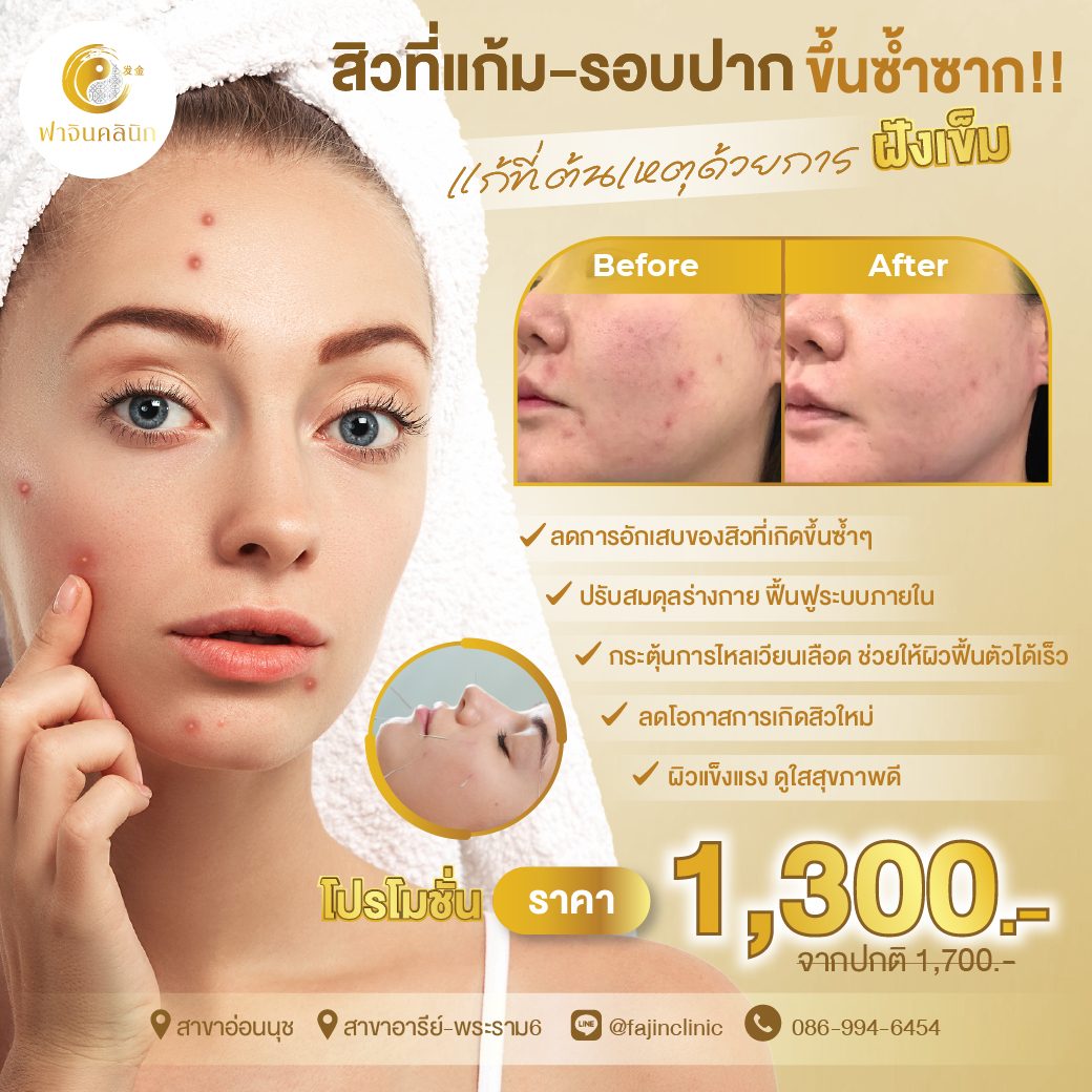 ฝังเข็มหน้าใส สิวขึ้นซ้ำซาก สิวที่แก้ว สิวรอบปาก ลดสิว