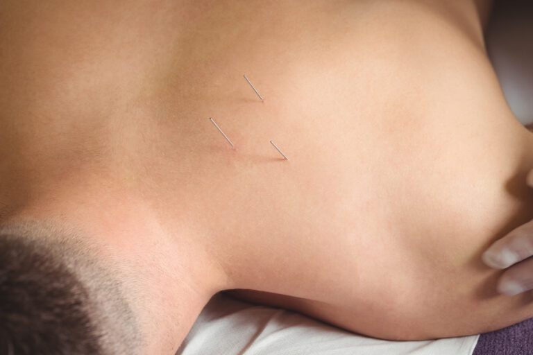 dry needling ทุยหนา ครอบแก้ว แก้ปวด ออฟฟิศซินโดรม