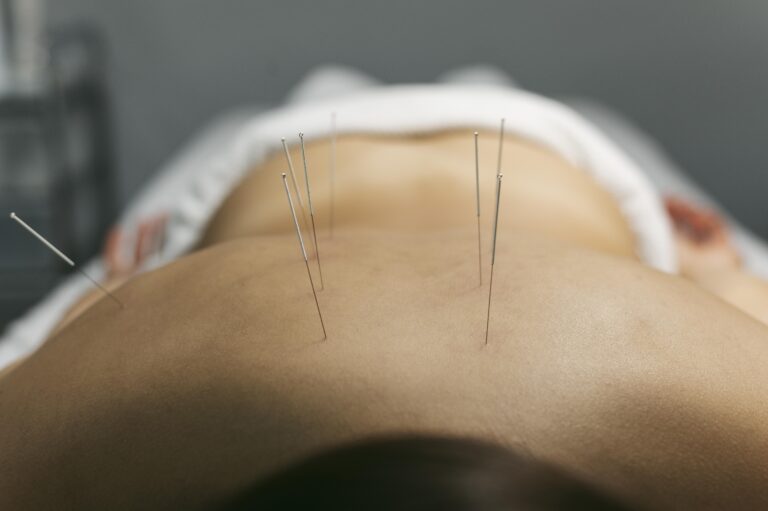 ฝังเข็ม dry needling ปวดหัว ไมเกรน ออฟฟิศซินโดรม คลายกล้ามเนื้อ