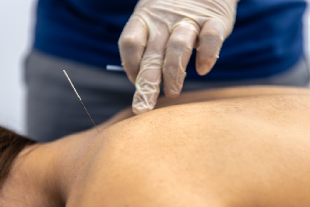 ฝังเข็ม dry needling ปวดหัว ไมเกรน ออฟฟิศซินโดรม คลายกล้ามเนื้อ