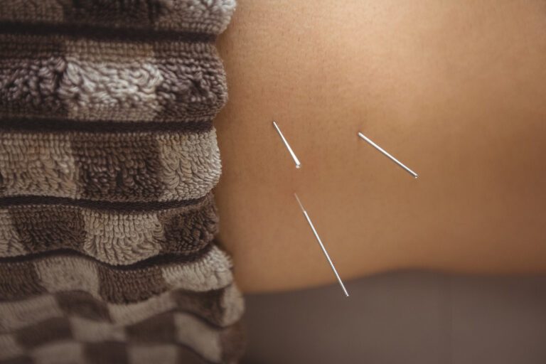 ปวดสลักเพชร ฝังเข็ม ปวดหลัง ปวดสะโพก dryneedling